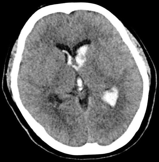 Plain CT Brain